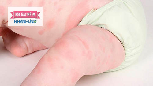 Mề đay gây sưng đỏ, mẩn ngứa tại nhiều vùng da trên cơ thể trẻ