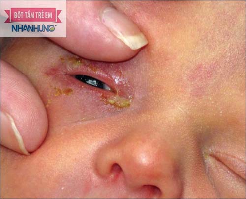 Trẻ bị tắc tuyến lệ thì lúc nào cũng chảy nước mắt