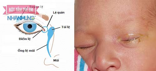 Dễ gây viêm nhiễm và nhiễm trùng mắt