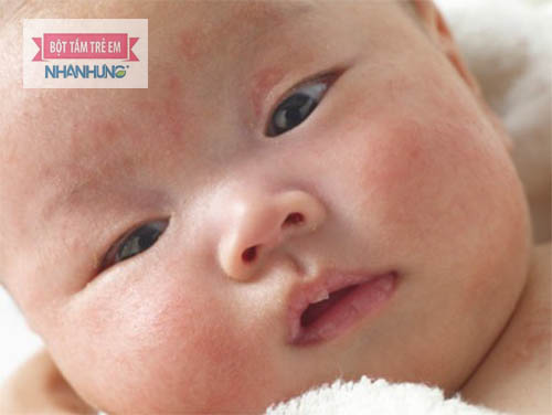 Viêm da dị ứng ở trẻ rất thường gặp
