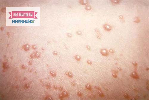  Trẻ bị viêm da cơ địa có khả năng cao nhiễm virus gây u mềm lây nhiễm