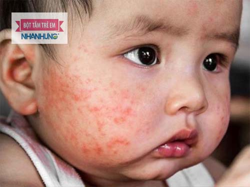  Viêm da cơ địa ở trẻ (Viêm da thể chàm) là bệnh mạn tính