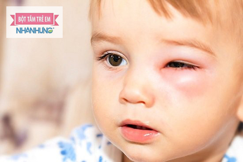 Chú ý vệ sinh mắt sạch sẽ cho con bằng nước muối sinh lý.