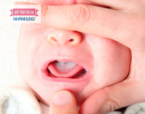 Niêm mạc lưỡi xuất hiện các màng màu trắng khi trẻ bị tưa lưỡi.