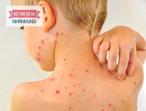 Thủy đậu dễ dàng nhận biết bởi các mụn nước dễ vỡ, ngứa và mọc khắp cơ thể