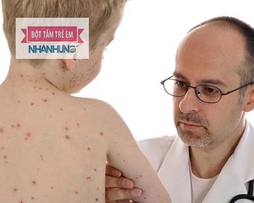  Bệnh phỏng dạ nếu không điều trị kịp thời có thể gây nhiều biến chứng đối với sức khỏe và mất thẩm mỹ cho bé sau này.