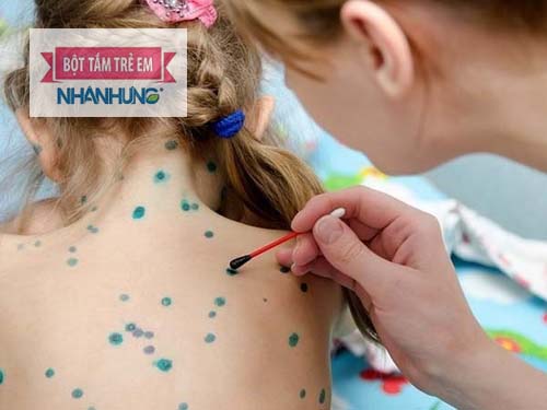  Dùng thuốc xanhmethylen để sát khuẩn các nốt bọng do phỏng dạ