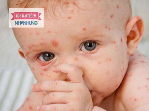  Bệnh phỏng dạ nếu không điều trị kịp thời có thể gây nhiều biến chứng đối với sức khỏe và mất thẩm mỹ cho bé sau này.