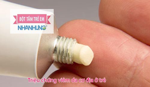 Trẻ bị viêm da cơ địa cần điều trị theo đơn của bác sĩ