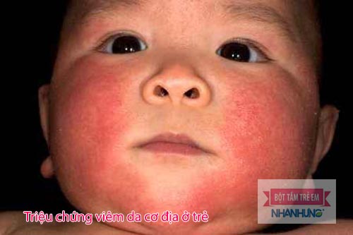 Viêm da cơ địa thường gặp ở trẻ nhỏ