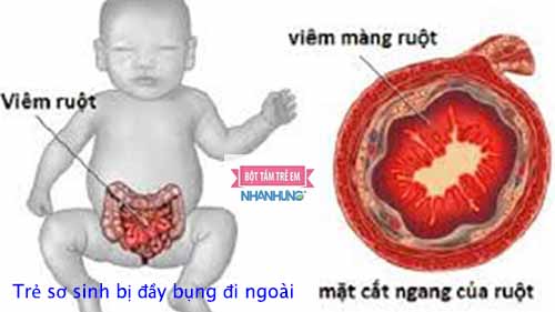 Do một số bệnh liên quan đến hệ tiêu hóa như, viêm ruột cấp tính, viêm dạ dày-thực quản…