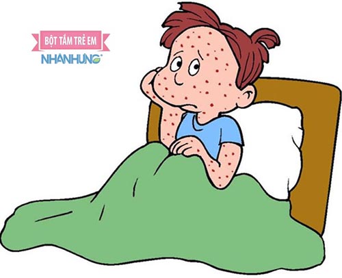 Cần cách ly người bị thủy đậu để tránh làm bệnh lây lan