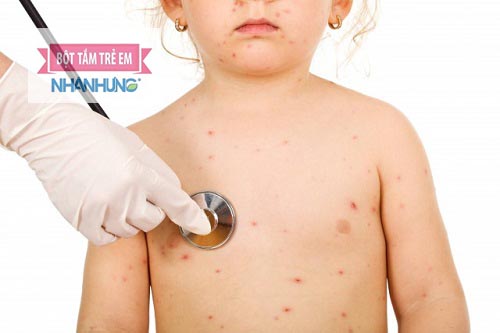 Người bị thủy đậu cần được chăm sóc đặc biệt để tránh lây nhiễm