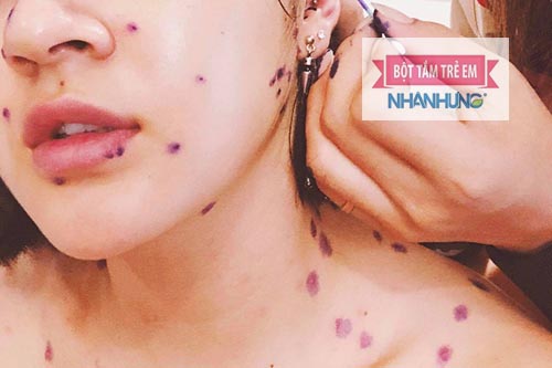 Xanh Metylen là thuốc chữa thủy đậu phổ biến