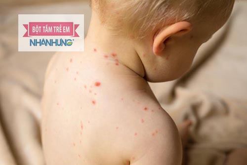 Giai đoạn toàn phát là lúc bệnh thủy đậu dễ lây nhiễm nhất