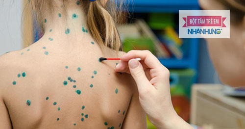 Sử dụng thuốc điều trị phỏng dạ cần theo chỉ định của bác sĩ