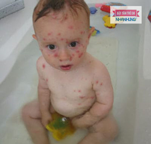 Bị phỏng dạ không cần kiêng nước như nhiều người vẫn nghĩ