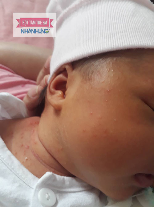 rôm sảy kết tinh