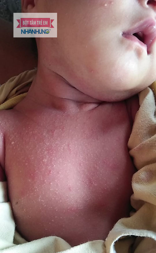 Rôm sảy kết tinh + rôm sảy mủ