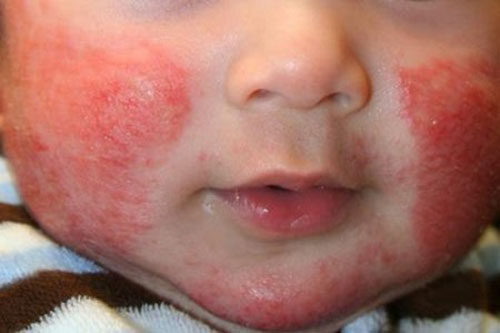 Nguyên tắc trị chàm sữa cần: Kháng khuẩn, chống viêm, giảm ngứa, dưỡng ẩm