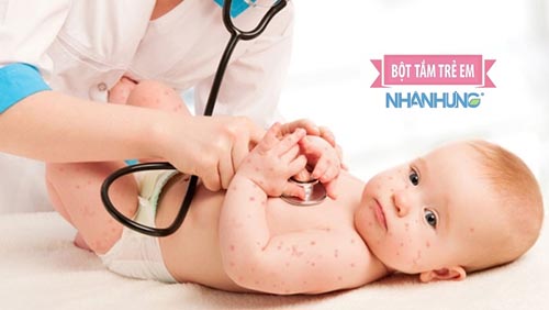 Sử dụng thuốc chữa thủy đậu theo chỉ định của bác sĩ