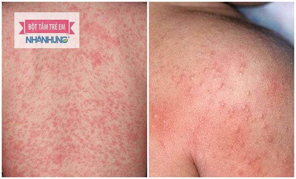 Rôm sảy – bệnh lý về da thường gặp ở trẻ trong mùa hè