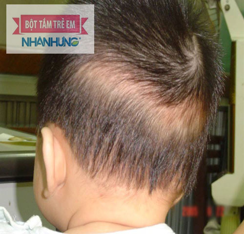 Trẻ bị rụng tóc vành khăn.