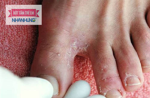 Nước ăn chân gây ngứa, bong tróc da, sưng nề và mưng mủ