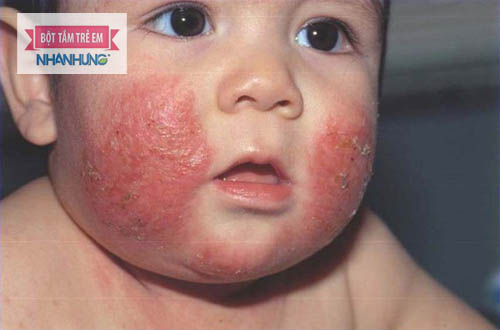 Chàm sữa nặng rất nguy hiểm