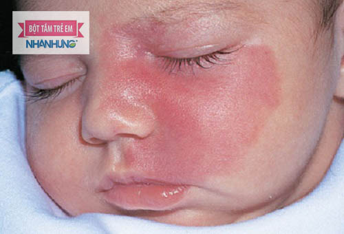 Chàm đỏ thường gặp nhiều nhất ở hai bên má của trẻ