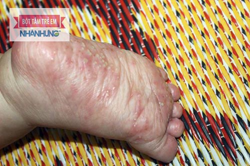 Mụn nước ở chân có thể là dấu hiệu của bệnh thủy đậu, ghẻ nước, chàm tổ đỉa