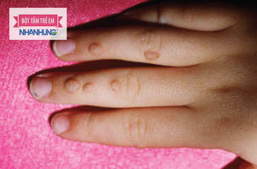 Mụn cơm do virus HPV loại 3 và virus HPV loại 10 gây nên