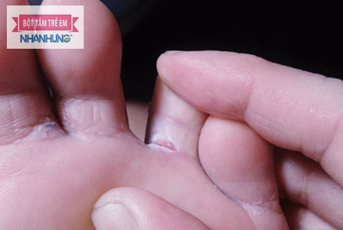 Nước ăn chân là do vi khuẩn nấm gây ra