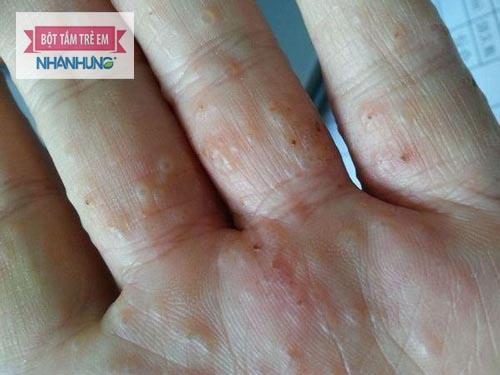 Mụn nước ở kẽ ngón tay rất phổ biến
