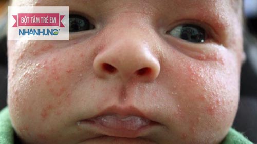 Kê sữa có thể gặp ở 40% trẻ sơ sinh