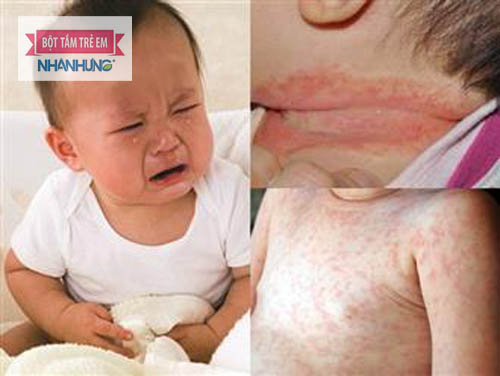 Nhiễm nấm men cũng là lí do khiến trẻ mẩn đỏ ở cổ 