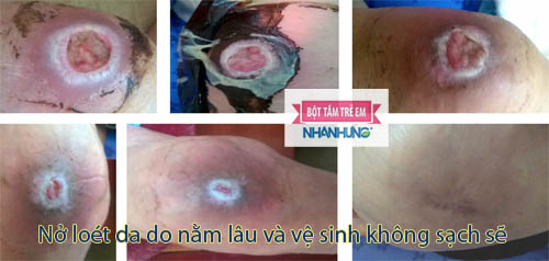 Ngày càng nhiều người da bị hăm loét da