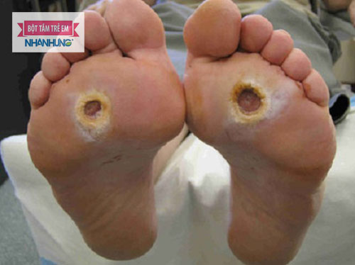 Ngày càng nhiều người da bị hăm loét da