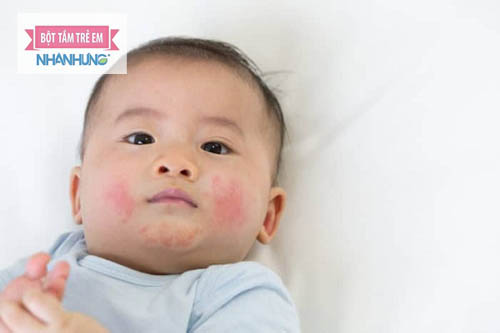 Chàm sữa có thể tái đi tái lại nhiều lần