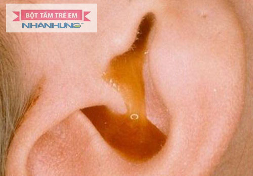 Bệnh viêm tai giữa giai đoạn cuối thường gây chảy mủ vàng.