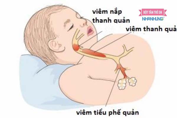 Bé thờ khò khè và ho do viêm phế quản