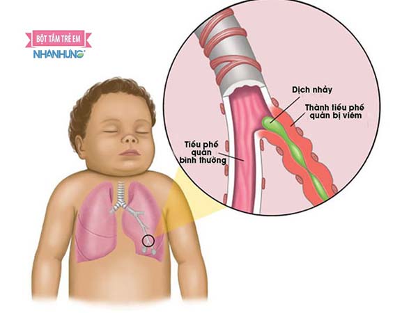 Bé thở khò khè và ho có thể do viêm phế quản