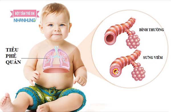 Bé bị viêm phế quản thở khò khè