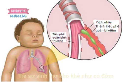 Trẻ sơ sinh thở khò khè như có đờm