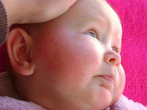 Giao mùa – thời điểm lý tưởng để chàm sữa ở trẻ phát triển