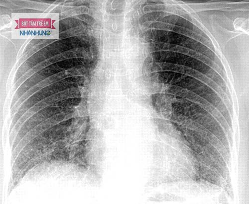 Trẻ bị viêm phổi thường thở nhanh hơn so với bình thường.