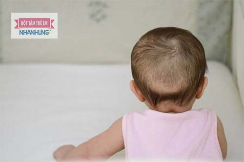 Bé bị rụng tóc vành khăn do thiếu chất.