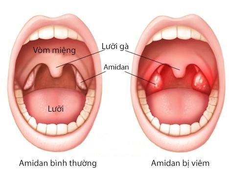  Viêm amidan có mủ là bệnh đang ở giai đoạn mãn tính.