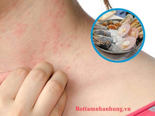Trẻ bị dị ứng hải sản bao lâu thì khỏi?