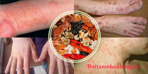 Biểu hiện dị ứng hải sản ở trẻ thường là các mẩn đỏ, ngứa ngáy khó chịu.